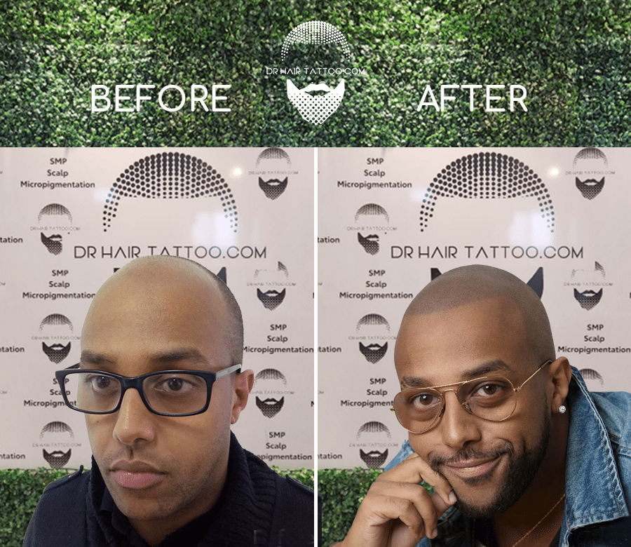 Scalp Micropigmentation (SMP) | Before & After | Ajax Durham Toronto GTA | Dr. Hair Tattoo