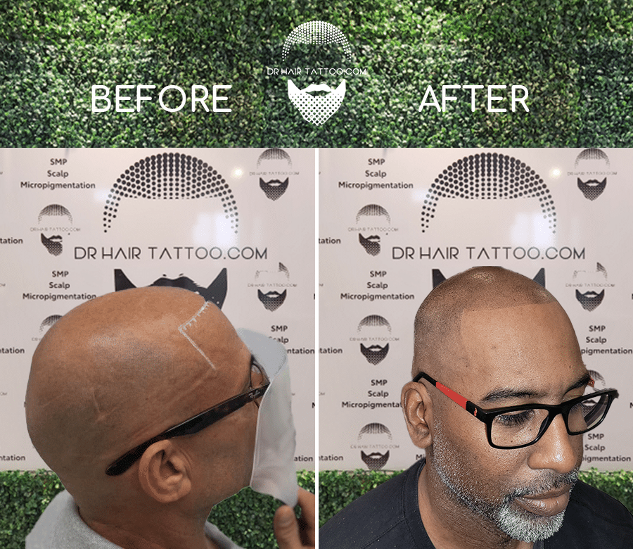 Scalp Micropigmentation Before & After Side Profile | Toronto Ajax Durham