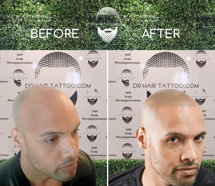 Toronto Ajax Durham | Scalp Micropigmentation (SMP) Before & After Side View