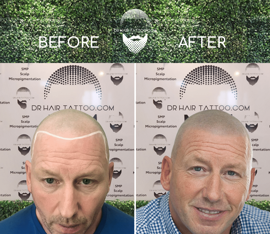 Toronto Ajax Durham | Scalp Micropigmentation (SMP) Before & After Front View