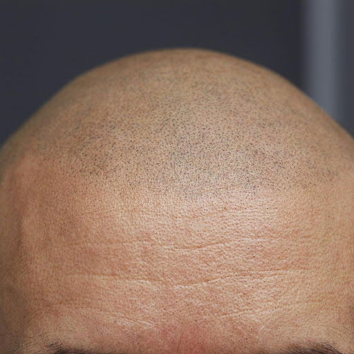 smp treatment result | Scalp Micropigmentation (SMP) Procedure | Ajax Durham Toronto GTA | Dr. Hair Tattoo